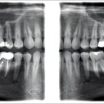 2d panoramik röntgen klinik görüntüleri