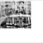 2d panoramik röntgen klinik görüntüleri 2