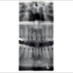 2d panoramik röntgen klinik görüntüleri 3