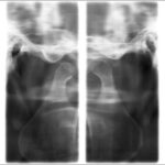 2D Panoramik Röntgen Klinik Görüntüleri 4