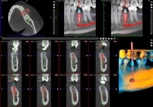 3D Cbct Dental Görüntüleme