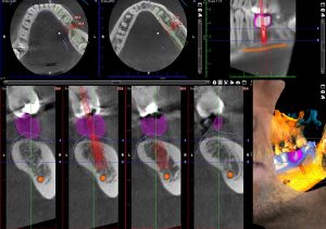 3D Cbct Diş Görüntüleme