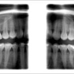 Planmeca Proone Bitewing 300×149