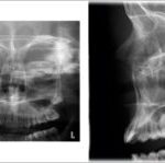 Planmeca Proone Pa Sinus And Lateral Rotational Sinus 300×149