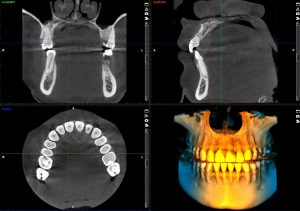 Promax 3D Classic Cbct Görüntü